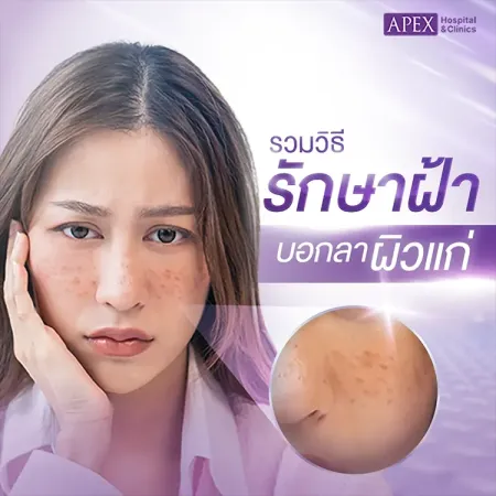 วิธีรักษาฝ้าให้หายขาด ให้ฝ้าดูจางลง พร้อมลดรอยดำ ทำอย่างไร