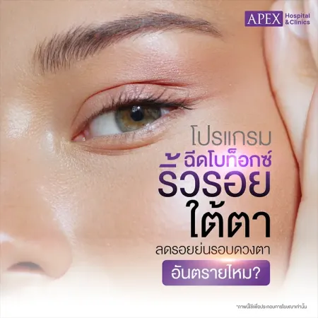 ฉีดโบท็อกซ์ริ้วรอยใต้ตา คืออะไร อันตรายไหม มีข้อดีข้อเสียอย่างไร