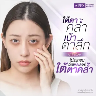 ฉีดฟิลเลอร์ใต้ตาคล้ำ คืออะไร แก้ปัญหาเบ้าตาลึก ตาล้า ไม่สดใส