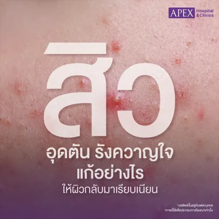 สิวอุดตัน คืออะไร เกิดจากสาเหตุ สิวหัวปิดกับไม่มีหัวต่างกันอย่างไร