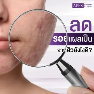 ลดรอยแผลเป็นสิว มีวิธีดูแลรักษาอย่างไร ไม่ให้กลับมาเป็นซ้ำ