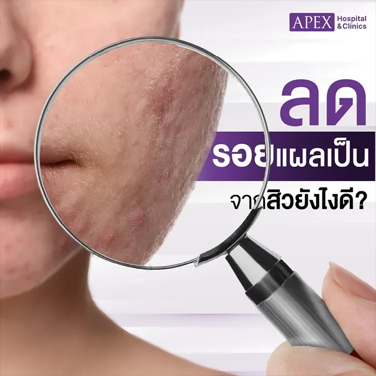 ลดรอยแผลเป็นสิว มีวิธีดูแลรักษาอย่างไร ไม่ให้กลับมาเป็นซ้ำ