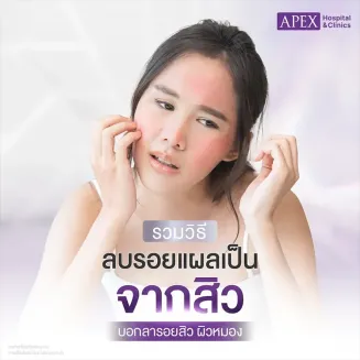 วิธีลบรอยแผลเป็นจากสิว เร็วที่สุด เห็นผลไว ผิวเรียบเนียนเป็นธรรมชาติ