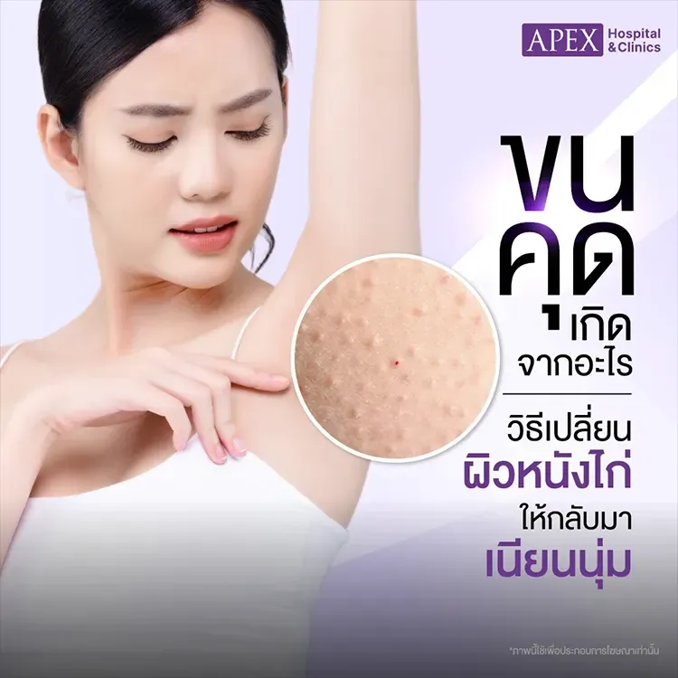 ขนคุด สาเหตุเกิดจากอะไร วิธีรักษาและป้องกันอย่างไร