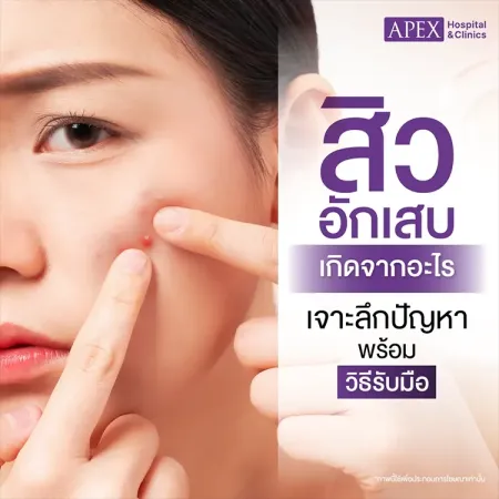 สิวอักเสบ คืออะไร เกิดจากสาเหตุ มีกี่ประเภท ต่างกันอย่างไร