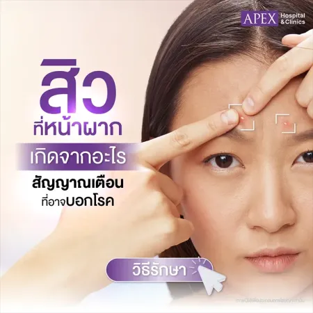 สิวขึ้นหน้าผาก คืออะไร เกิดจากสาเหตุ มีกี่ประเภท ต่างกันอย่างไร