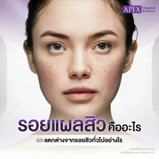 รอยแผลสิว คืออะไร สาเหตุเกิดจาก มีวิธีรักษาป้องกันอย่างไร