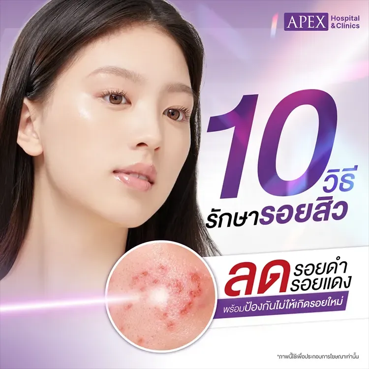 รอยสิว คืออะไร สาเหตุเกิดจาก 10 วิธีรักษาป้องกันไม่ให้เกิดรอยใหม่