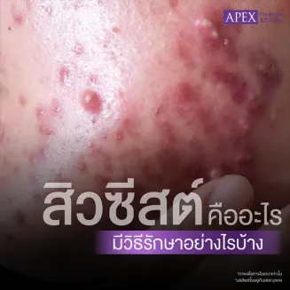 สิวซีสต์ คืออะไร สาเหตุเกิดจาก มีวิธีรักษาป้องกันอย่างไร
