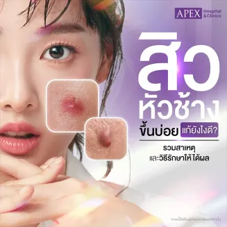 สิวหัวช้าง คืออะไร สาเหตุเกิดจาก มีวิธีรักษาป้องกันอย่างไร