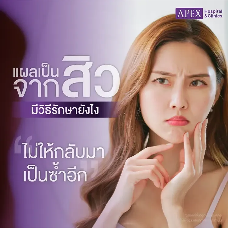 แผลเป็นจากสิว สาเหตุเกิดจากอะไร วิธีรักษาและป้องกันอย่างไร