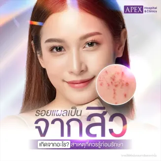 รอยแผลเป็นจากสิว มีกี่ประเภท วิธีรักษาสิวป้องกันอย่างไร