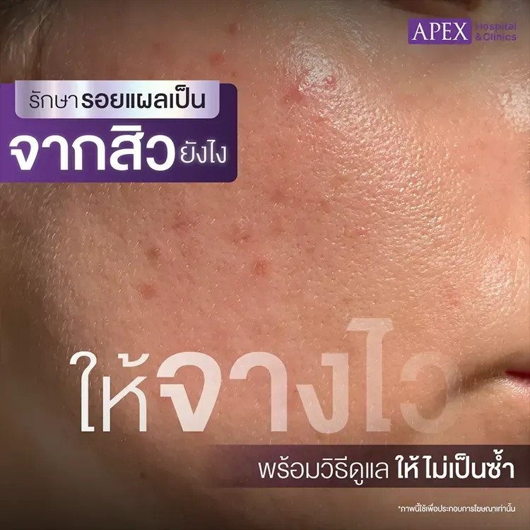 วิธีรักษารอยแผลเป็นจากสิว แต่ละประเภท มีข้อดีข้อเสียแตกต่างกันอย่างไร