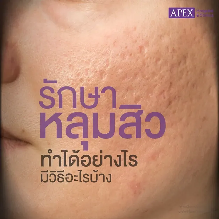 รักษาหลุมสิวมีกี่วิธี กี่ประเภท อะไรบ้าง แตกต่างกันอย่างไร