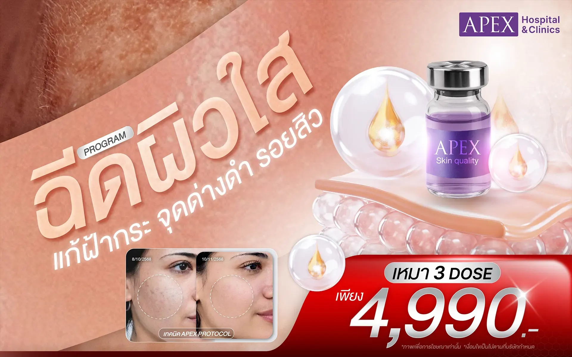 ฉีดผิวใส 4990