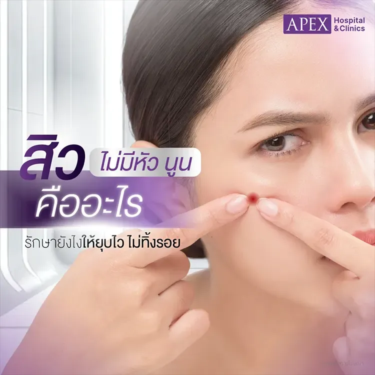 สิวไม่มีหัว นูนๆ รักษายังไง กี่วันหาย ทำอย่างไรไม่ให้เกิดรอยดำ