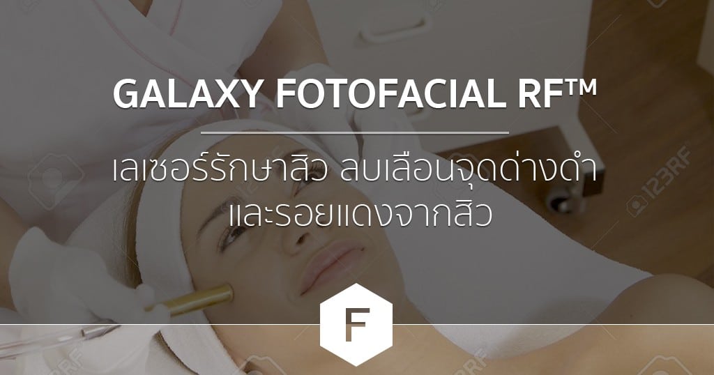 GALAXY FOTO FACIAL RF™ : เลเซอร์รักษาสิว ลบเลือนจุดด่างดำ รอยแดงจากสิว