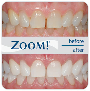 zoom-teeth-whitening-before-after-la-mesa-village-ca