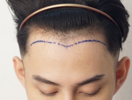Hair Transplant : Hair Line 