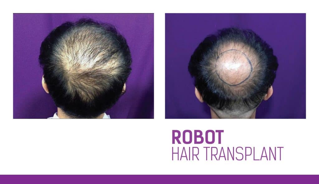 Robotic Hair Transplantation