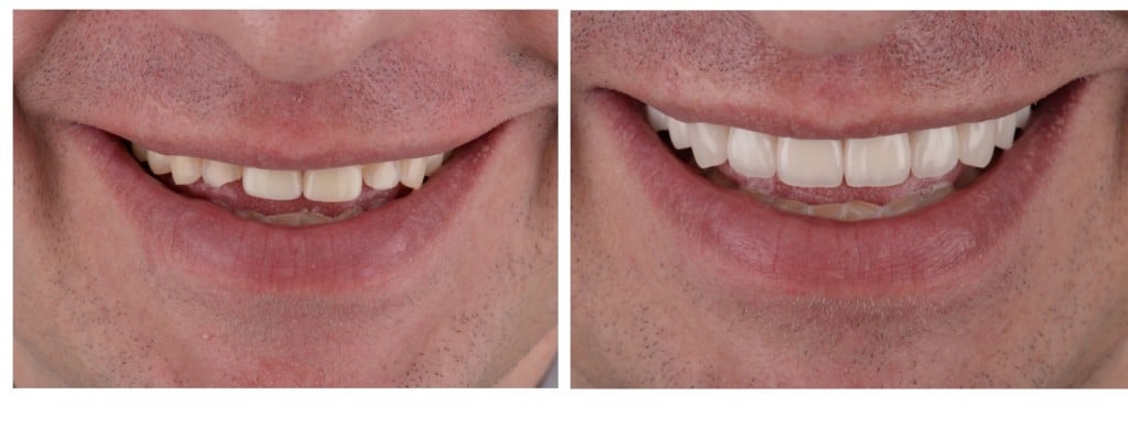 รักษาฟันแตก บิ่น ห่าง ด้วยทันตกรรมความงามเคลือบผิวหน้าฟัน…วีเนียร์ (Veneers)