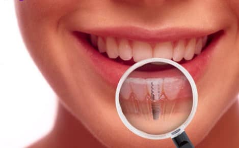 Immediate Implant การปลูกรากฟันเทียม แบบมีรากฟันทันทีหลังถอนฟัน