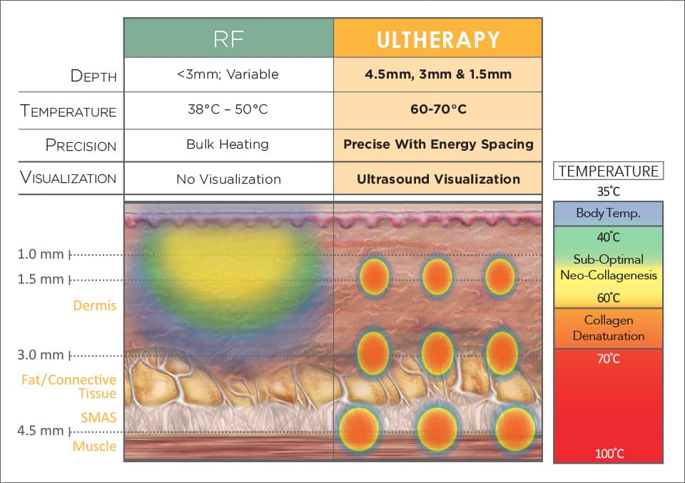 ultherapy vs rf devices