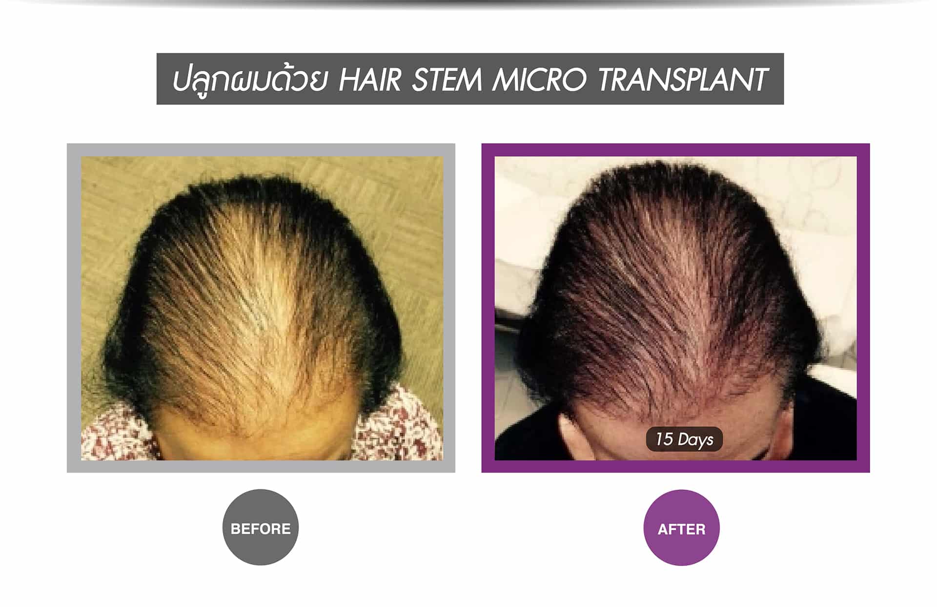 Breakthrough Stem Cell Treatment for Hair Loss - Apex Profound Beauty