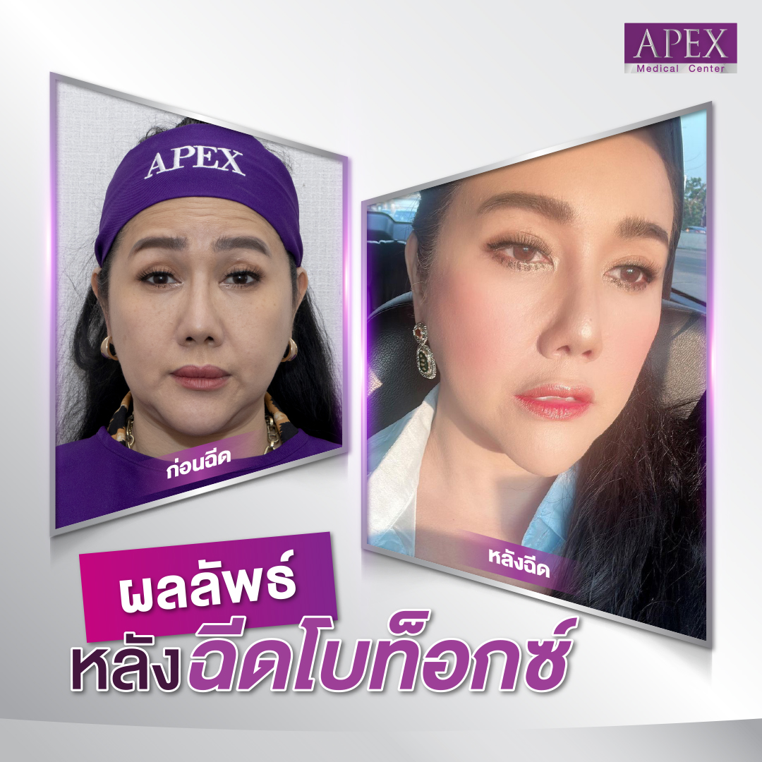Botox review by APEX