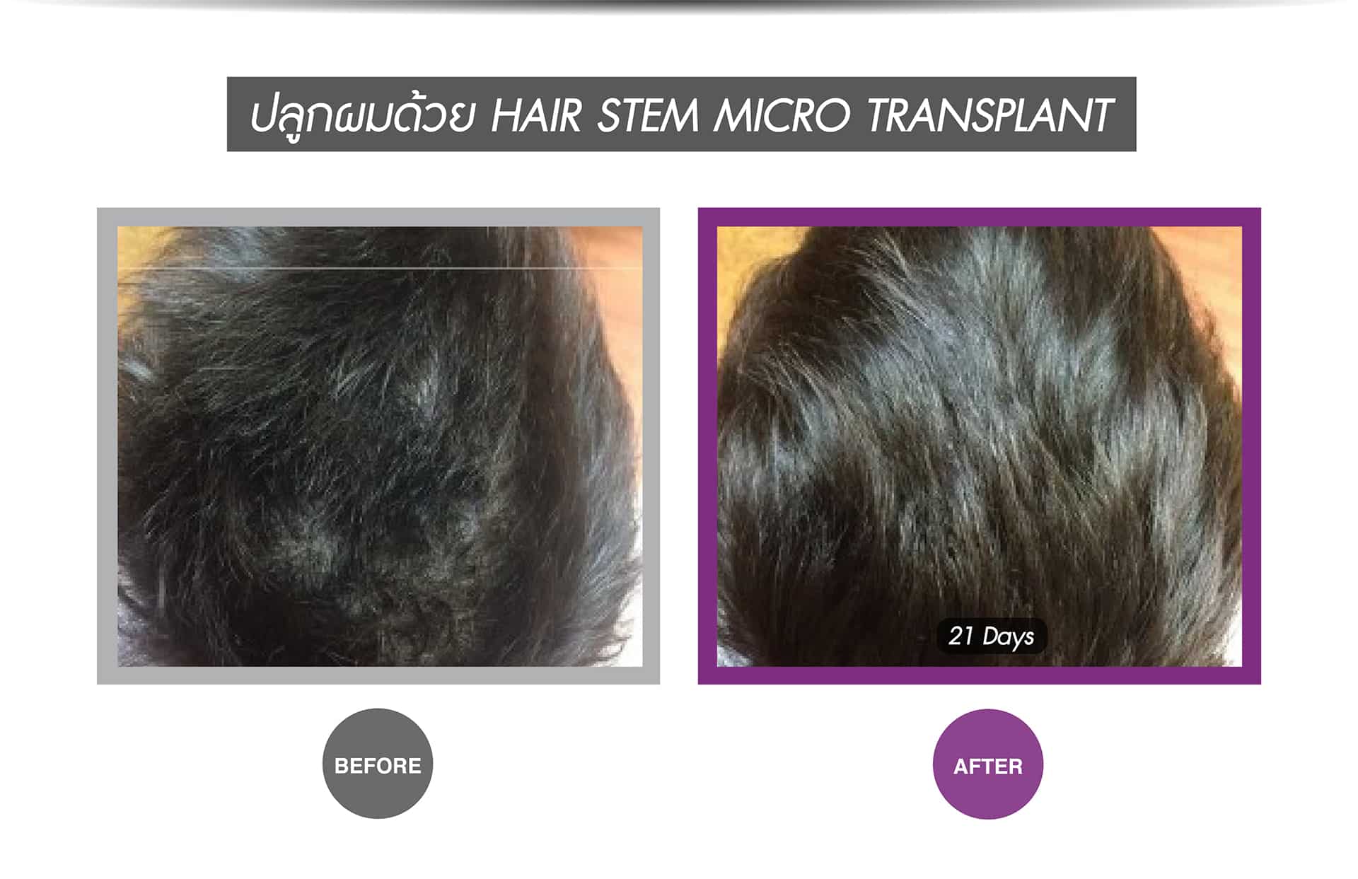 Hair Stem Micro Transplant-8