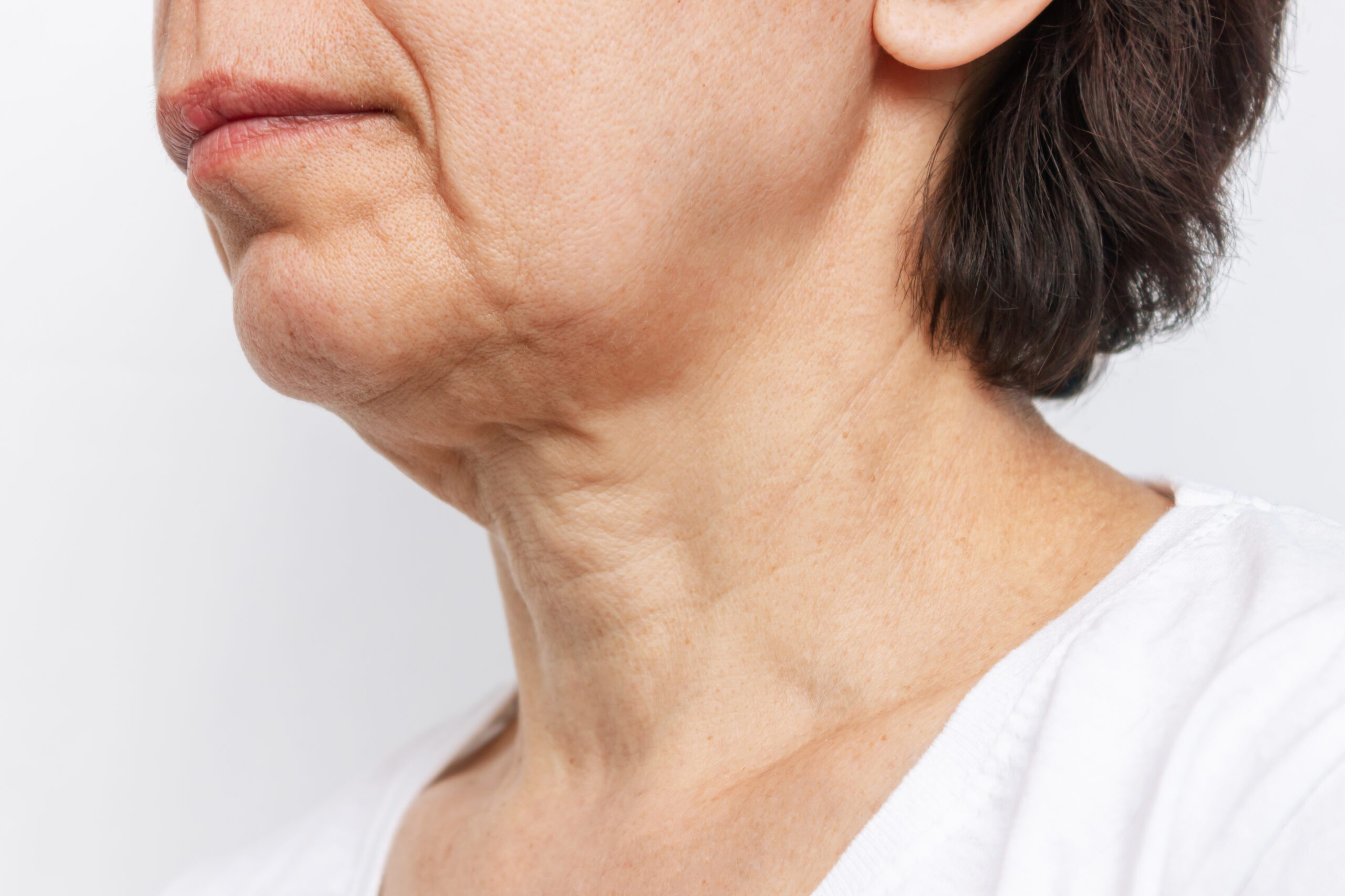 Sagging skin is caused by the inability of the skin to produce new collagen and elastin. thus causing sagging as we age