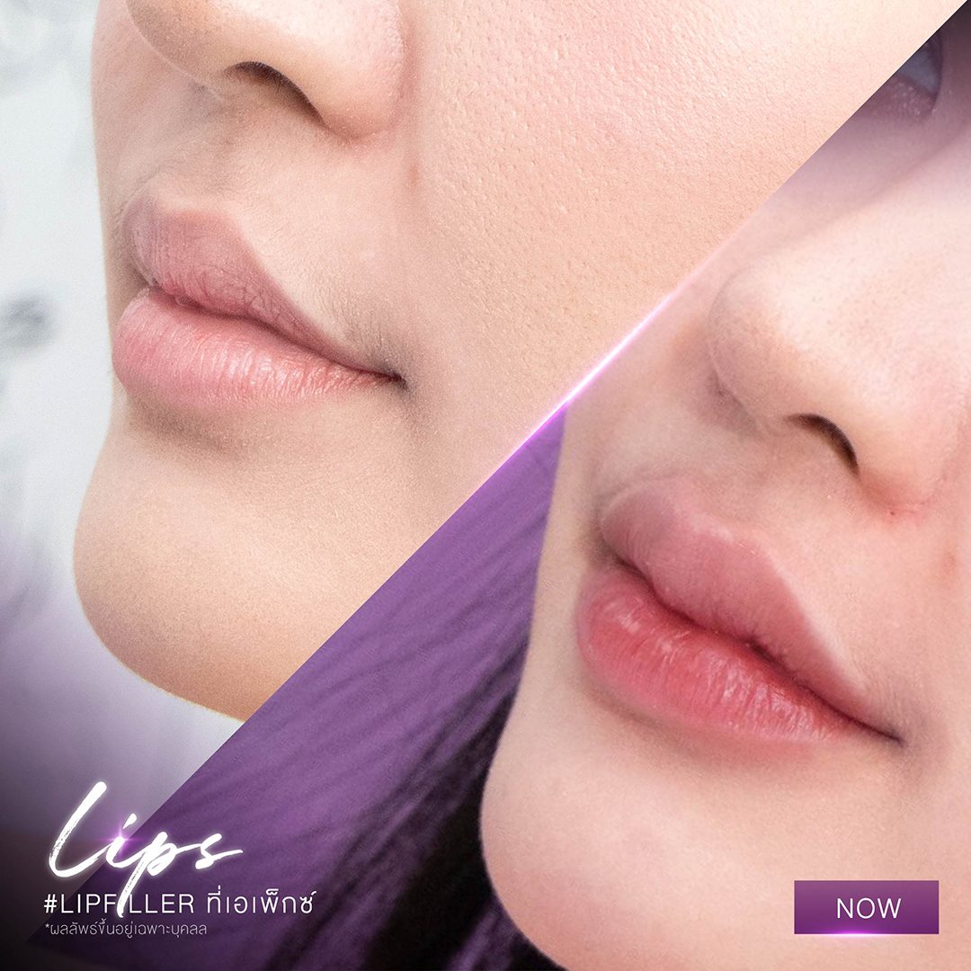 Lip fillers are one of the most popular types of dermal fillers