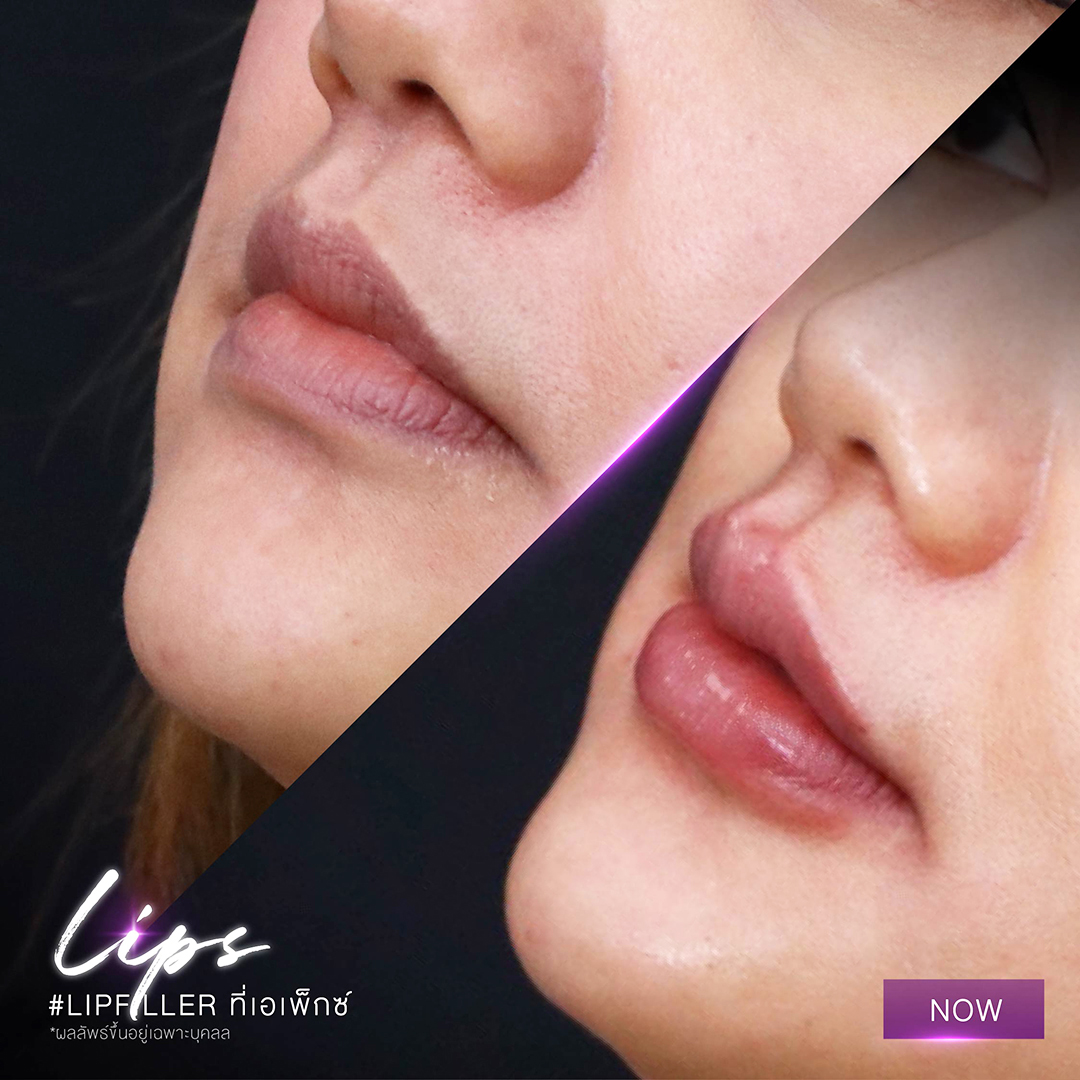 Lip fillers are one of the most popular types of dermal fillers