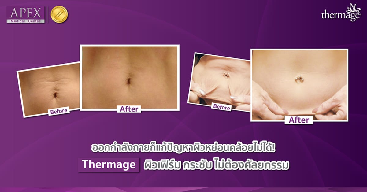 Thermage FLX Body 