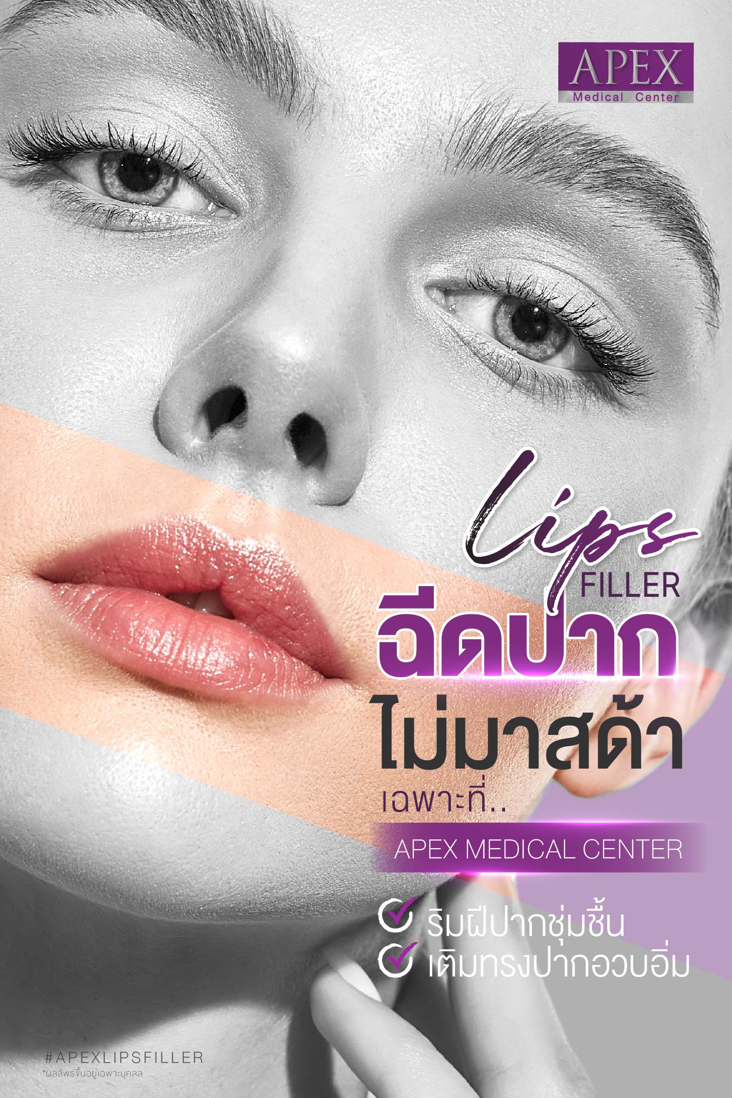 Filler injections for plump lipsare a series of injections that shape and plump up your lip.