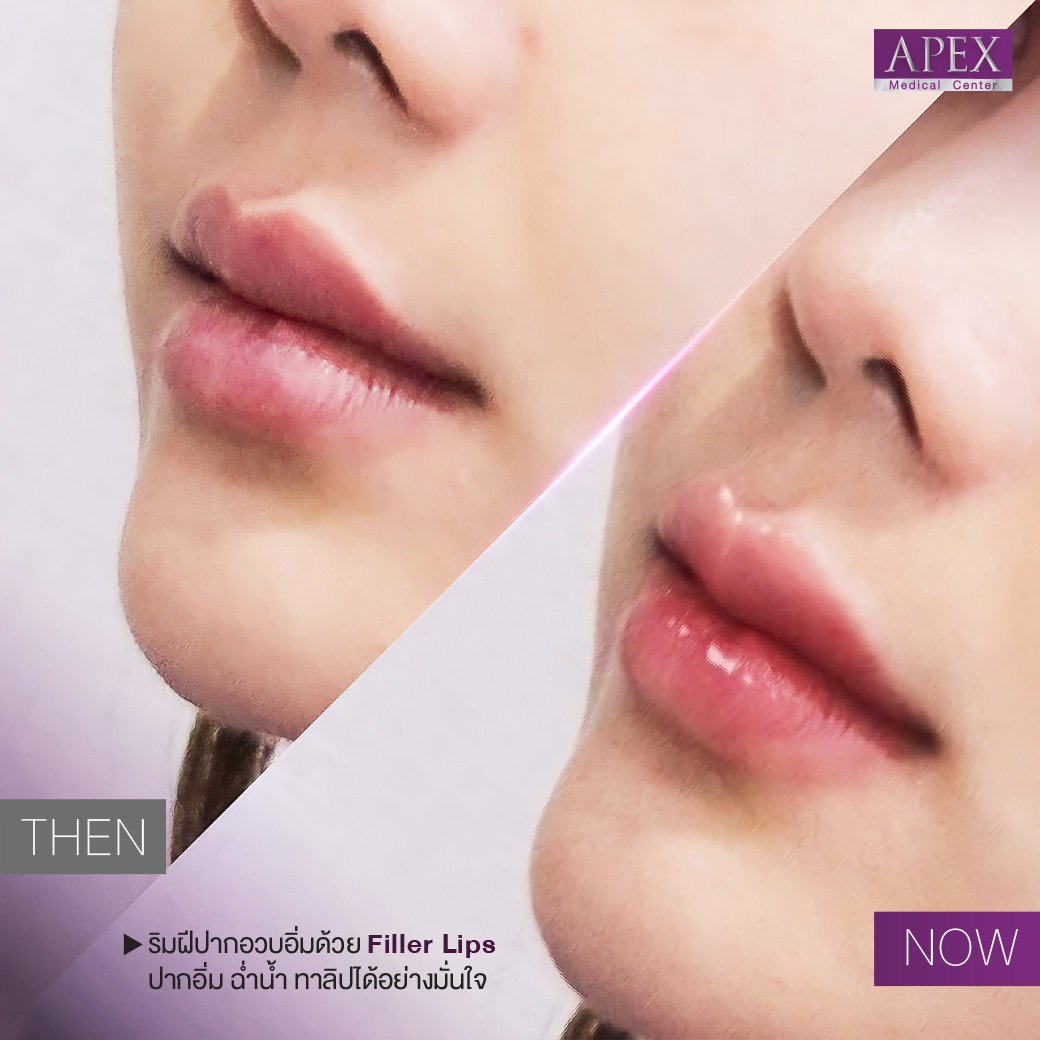 Review injection filler lips at Apex Medical Center , Bangkok Thailand