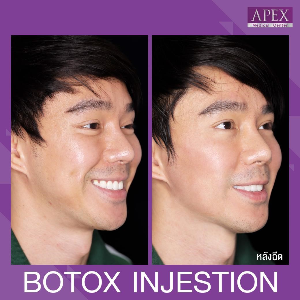 botox injections for men It is also popular to inject to reduce sweat. It can also reduce body odor. The advantages are Botox injections for men. The results can be seen after only 1-2 weeks of injection and the results last for 3-4 months.