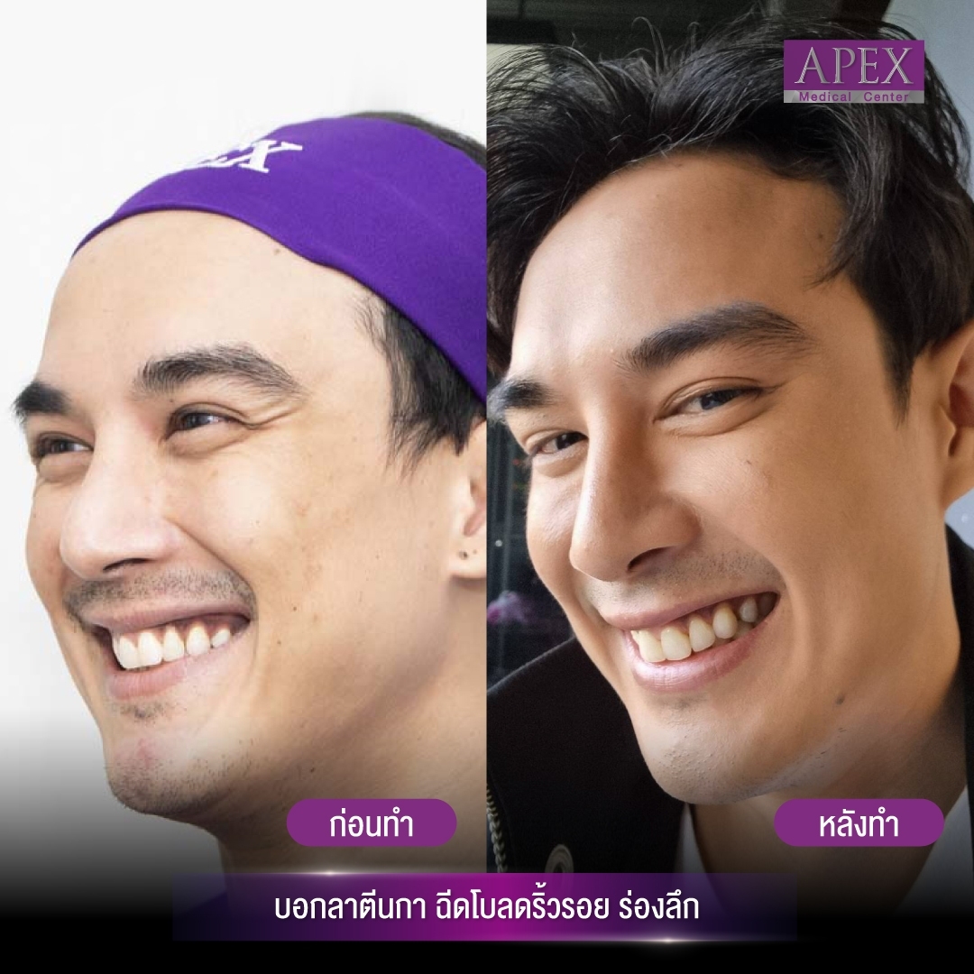 botox injections for men It is also popular to inject to reduce sweat. It can also reduce body odor. The advantages are Botox injections for men. The results can be seen after only 1-2 weeks of injection and the results last for 3-4 months.