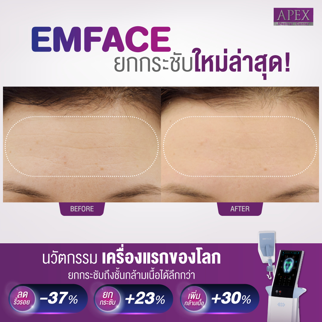EMFACE is a revolution in facial treatments. By emitting both synchronized RF and HIFESTM energies, it simultaneously affects the facial skin and muscles. The end result is less wrinkles and more lift naturally without needles. 