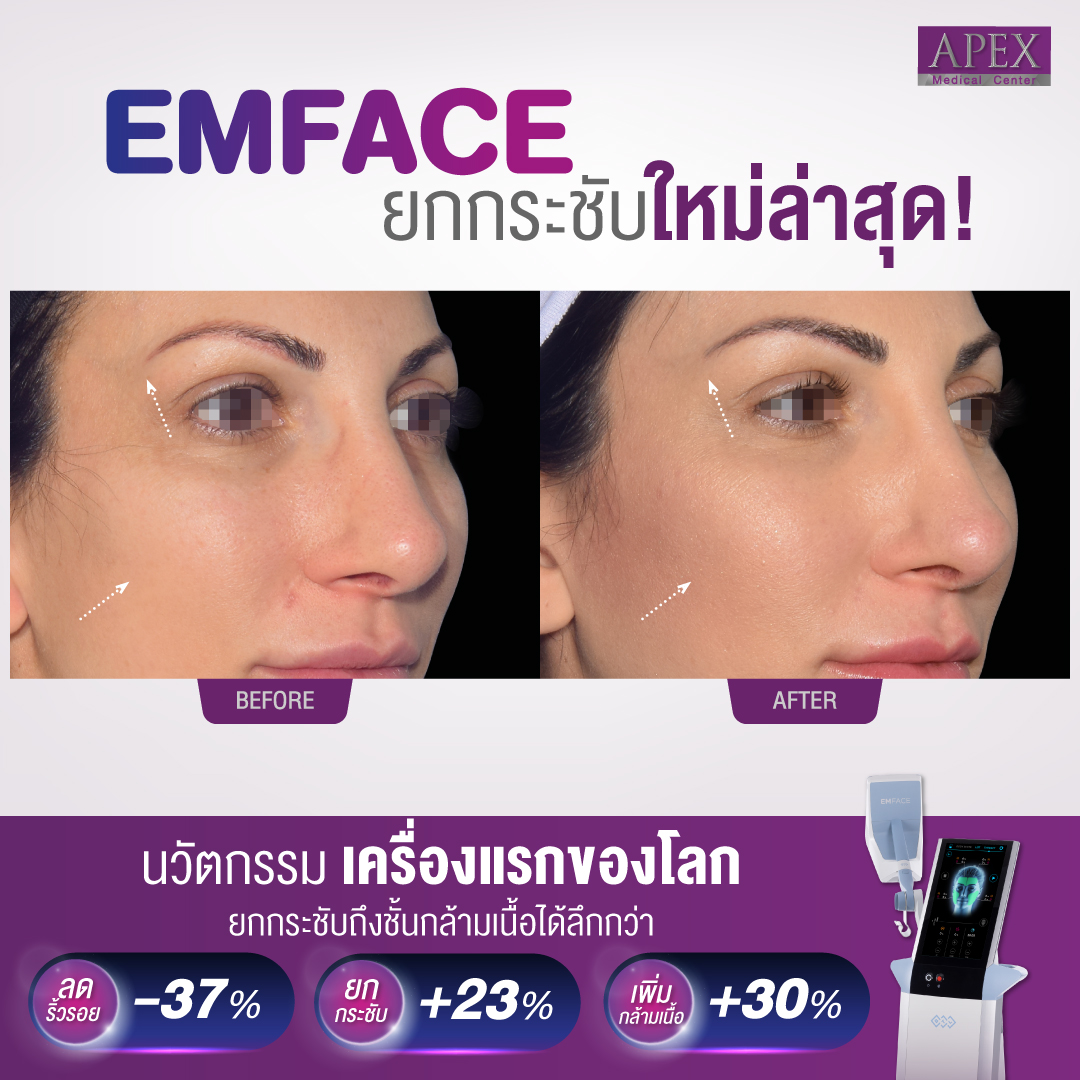 EMFACE is a revolution in facial treatments. By emitting both synchronized RF and HIFESTM energies, it simultaneously affects the facial skin and muscles. The end result is less wrinkles and more lift naturally without needles. [4]