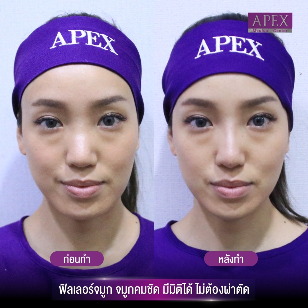 Results after nose filler injections at APEX