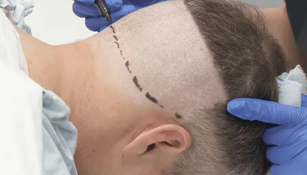 Robot Hair Transplant