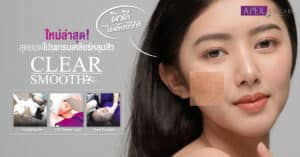 Acne hole treatment with StartWalker laser by Apex Medical Center