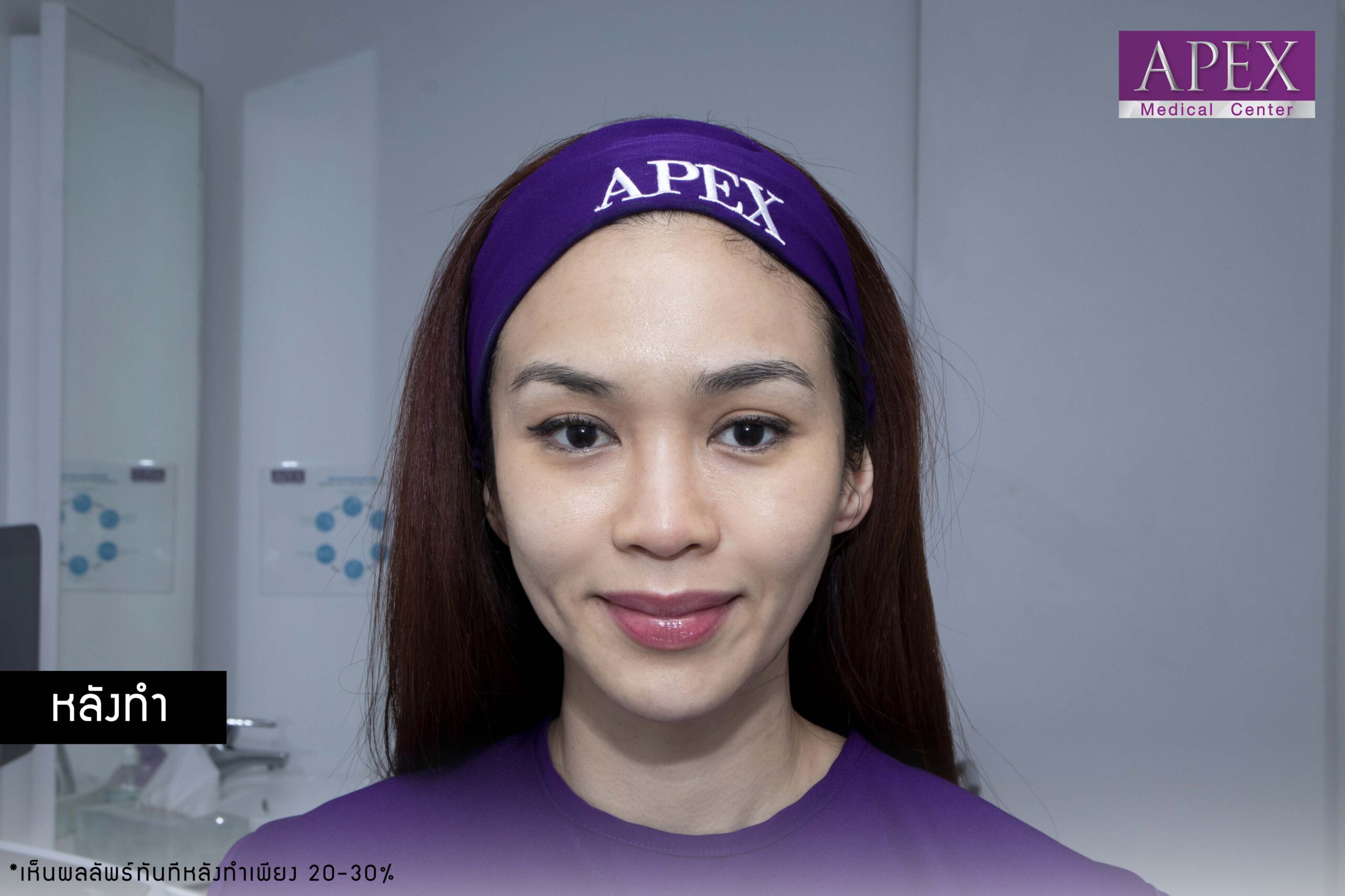 Face and skin after Thermage. The result is firmer skin, clearer facial contours, and lifted eyebrows.