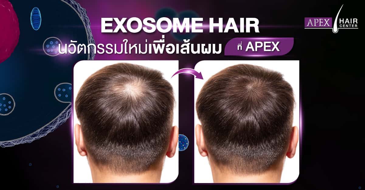 EXOSOME HAIR LOSS TREATMENT Exosomes hair loss treatment is advanced in stem cell therapy without using actual stem cells but by using ‘communicating vesicles’ to stimulate your own stem cells to release growth factors. They are less risky than actual stem cells as they can not trigger autoimmune or allergic reactions. They are such small particles that even through a small skin injury can penetrate the skin and work locally as well as systemically through the bloodstream.