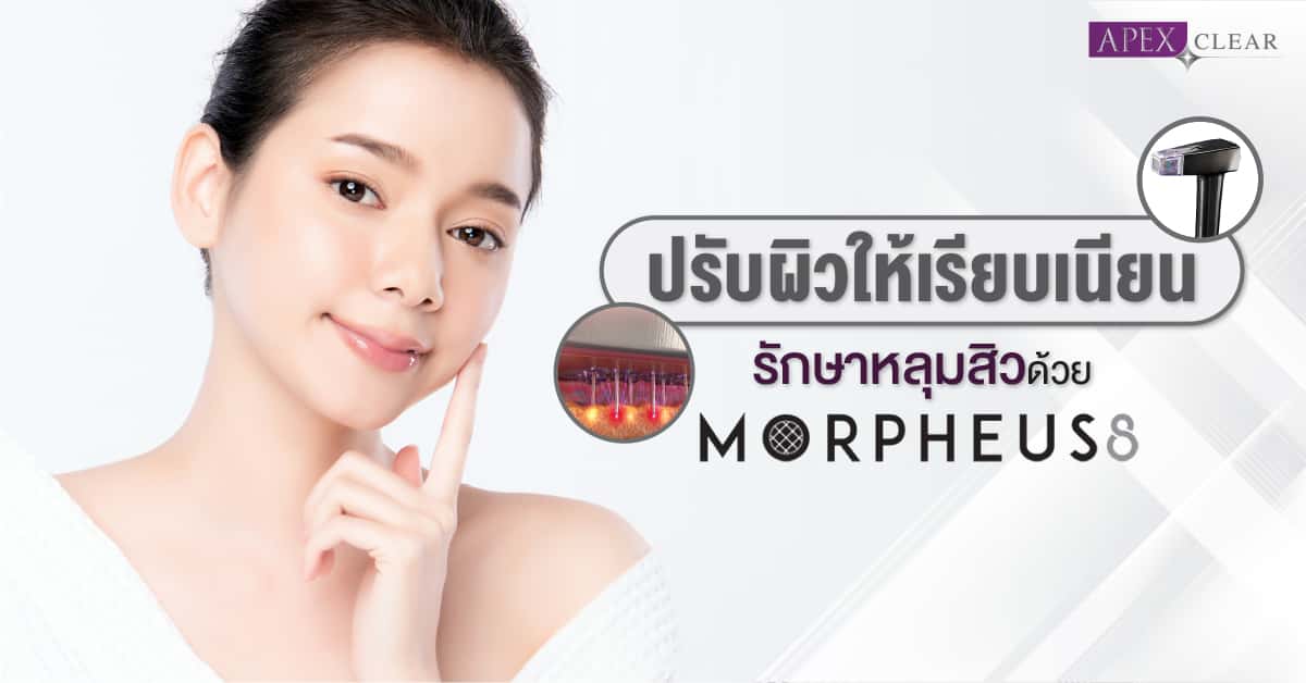 Morpheus8 is a non-surgical advanced needling treatment.