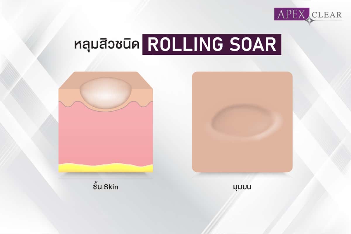 Rolling scars happen because of bands of scar tissue that form under the skin They give the surface of the skin a rolling and uneven appearance. They also develop because of dermal tethering to the subcutis tissue