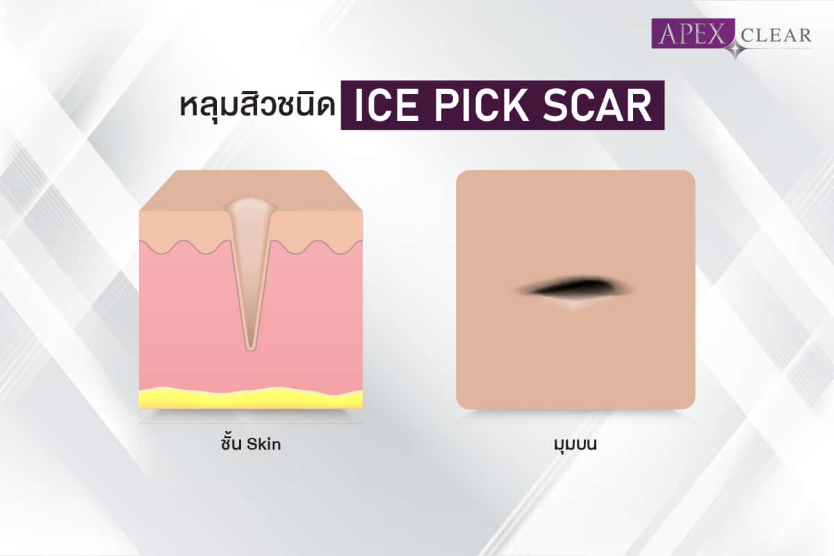 Ice pick scars are deep acne scars that make the skin look like it has been punctured with a tiny ice pick, and they are difficult to treat.