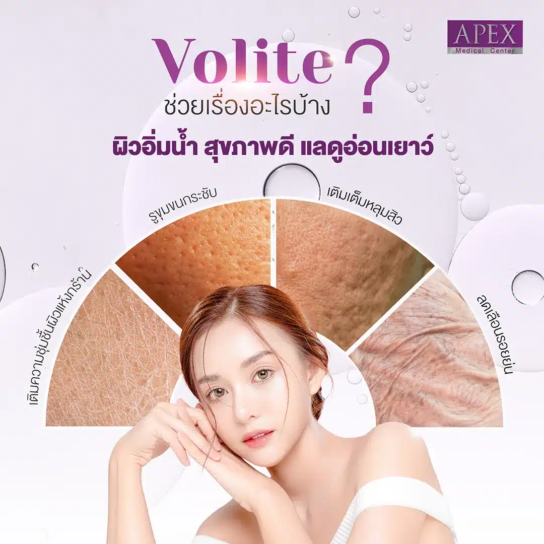 Volite is a type of Hyaluronic Acid (HA) Filler that is more special than previous fillers because Volite is designed to inject into the middle layer of the skin. Effectively directly add moisture to the dermis with hyaluronic acid that helps absorb water and retain moisture. [4]