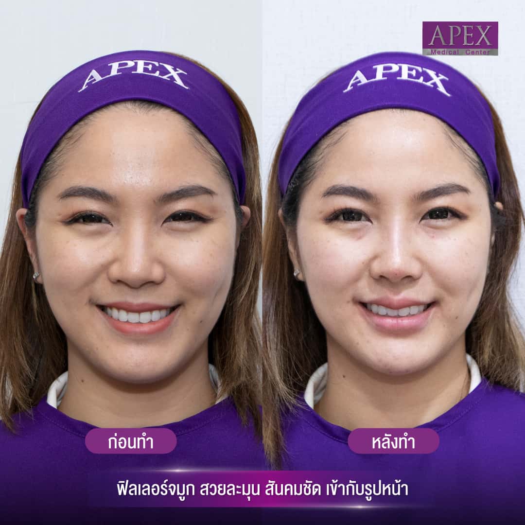 Nose fillers are hyaluronic acid (HA) It is a unique technique of injecting the filler in the nose so that the nose can be lifted in a strucutred manner to produce cosmetically satisfying nose shape